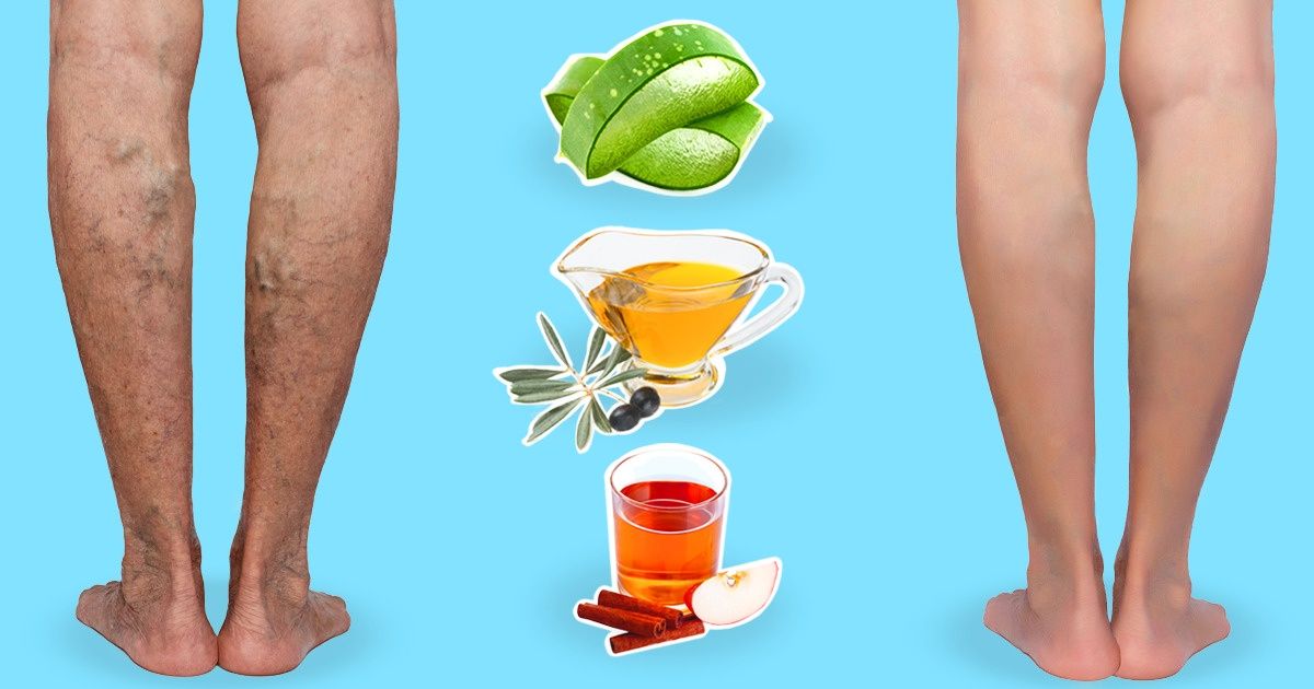 Are Natural Remedies Effective in TREATING VARICOSE VEINS?