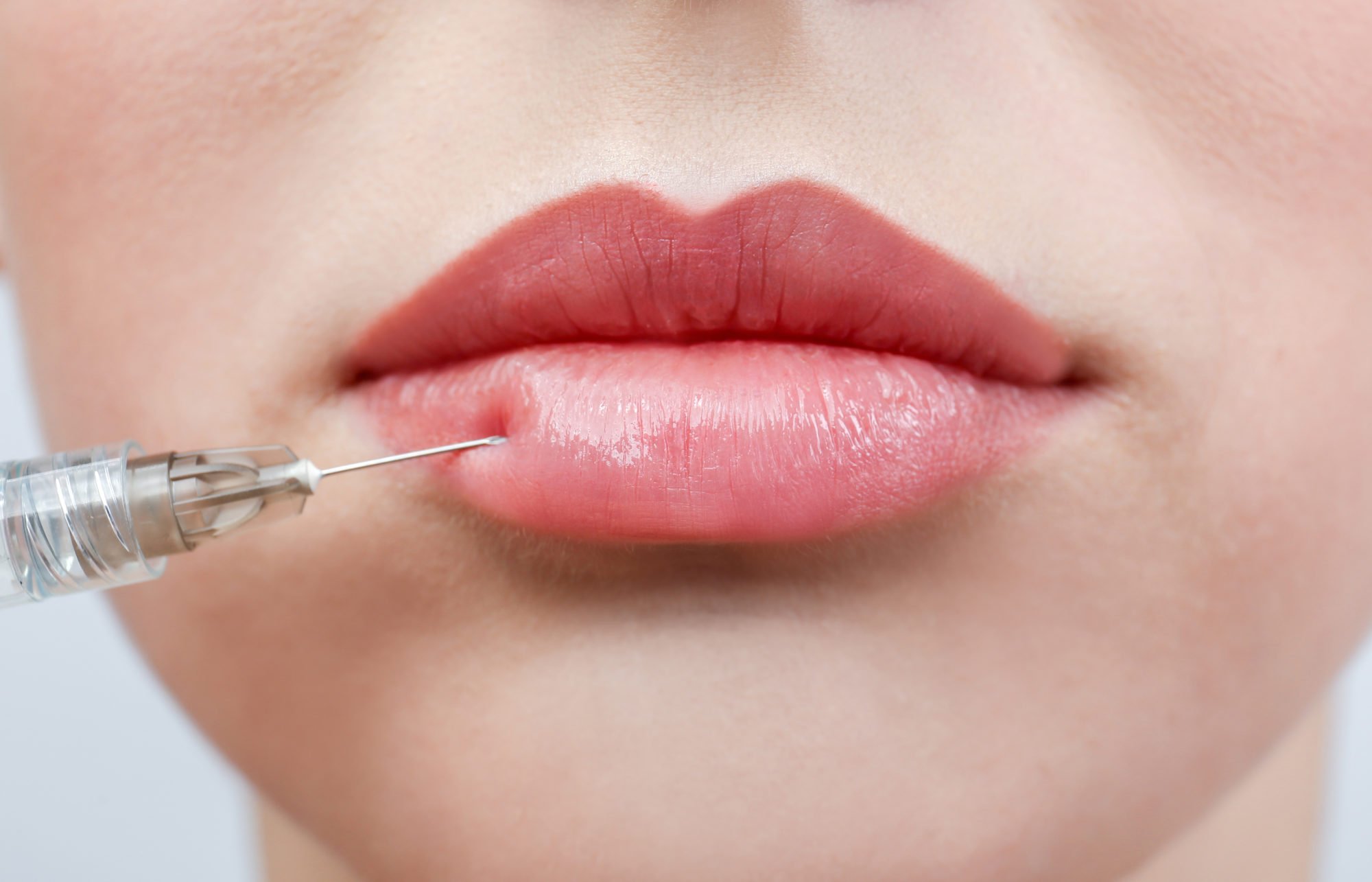 What Are The Things One Should Keep In Mind After Using Dermal Fillers?