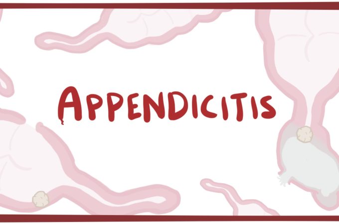 What Are The Common Signs Which Are Seen In Appendicitis?